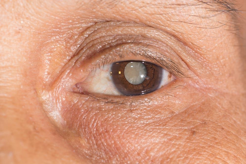 Cataract in eye close up